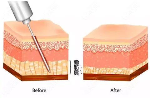 抽脂手術(shù)對身體有什么傷害？該不該禁止抽脂手術(shù)？